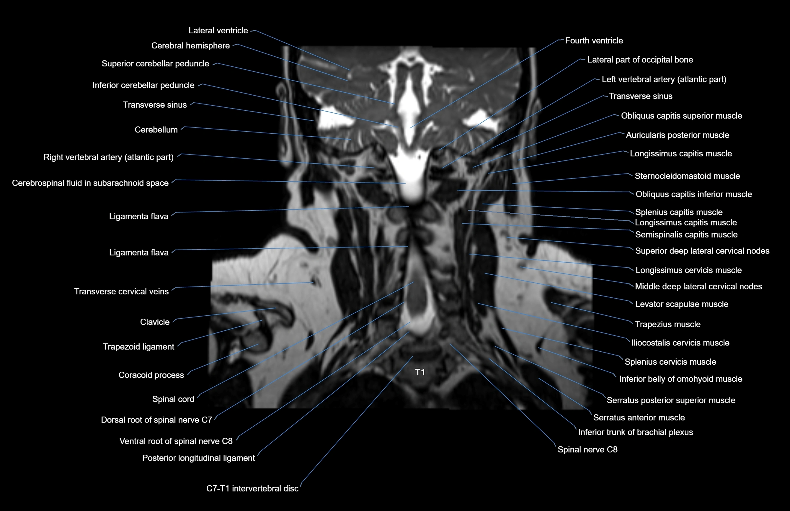 Neck coronal cross sectional MRI anatomy 3T MRI  image-img-00001-00021.webp